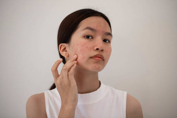 Cropped shot of a young woman squeezing a pimple on her face